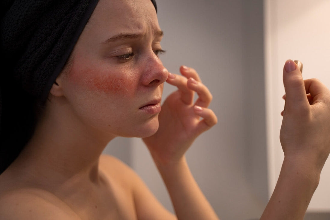 Best Supplement for Rosacea